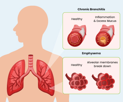 Chronic Obstructive Pulmonary Disease