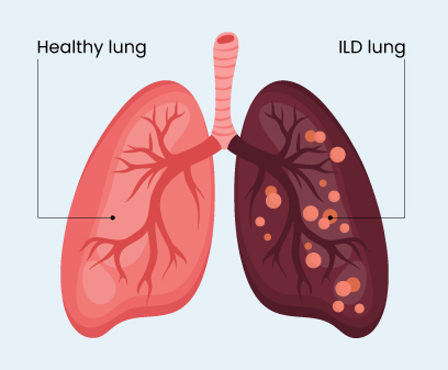 Interstitial lung disease