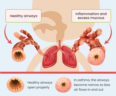 Paediatric Asthma